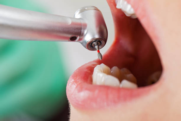 Best Emergency Tooth Extraction in Fort Meade, MD